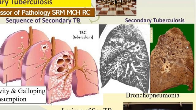 PULMONARY TUBERCULOSIS | Pathology | RATS | MBBS| SRM | Dr GSS | University Exam Chart смотреть онлайн