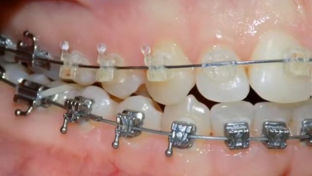 Открытый прикус смотреть онлайн