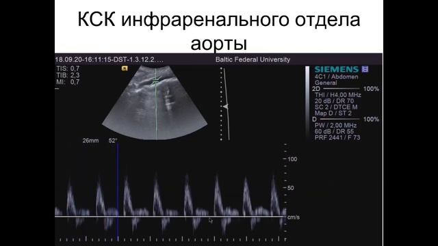 Введение в допплерографию. 2 часть. Количественные допплерографические показатели кровотока