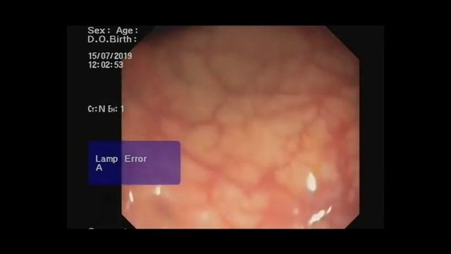 Patient With ME/CFS Symptoms, Colonoscopy. Infection/