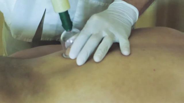 Хиджама(медициннское кровопускание)/hidjama смотреть онлайн