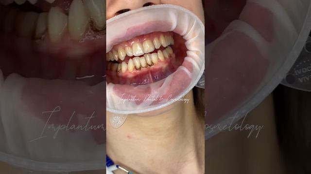 🔹 Установлены керамические виниры e-max 🔹 Цвет - блич 2🔹 Штук - 22🔹 Доктор - Давит Матевосян смотреть онлайн
