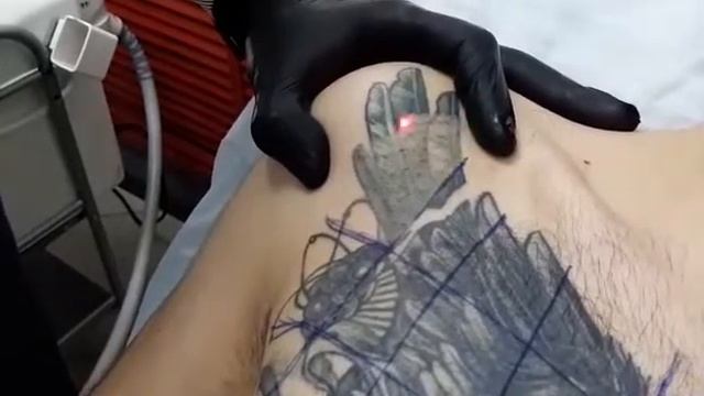 Удаление татуировок Ростов на Дону смотреть онлайн