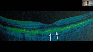 Возрастная макулярная дегенерация. Сухая форма.mp4