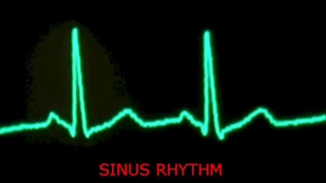 audible heart beat - extrasystoles / PVC and sinus beats смотреть онлайн