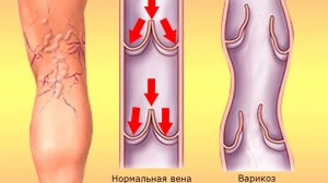 ТОП-5 Сильных СРЕДСТВ от варикозного расширения вен!
