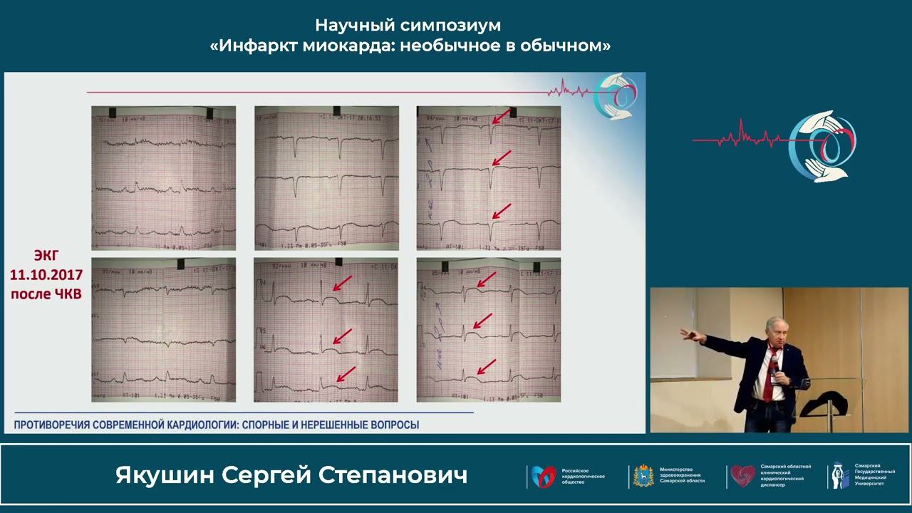 22.10 Научный симпозиум «Инфаркт миокарда: необычное в обычном» смотреть онлайн