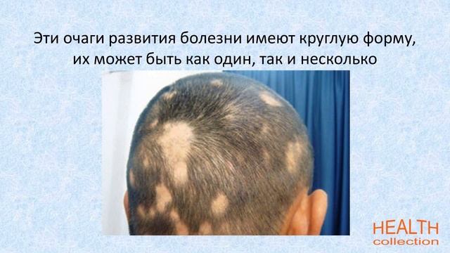 Симптомы облысения смотреть онлайн