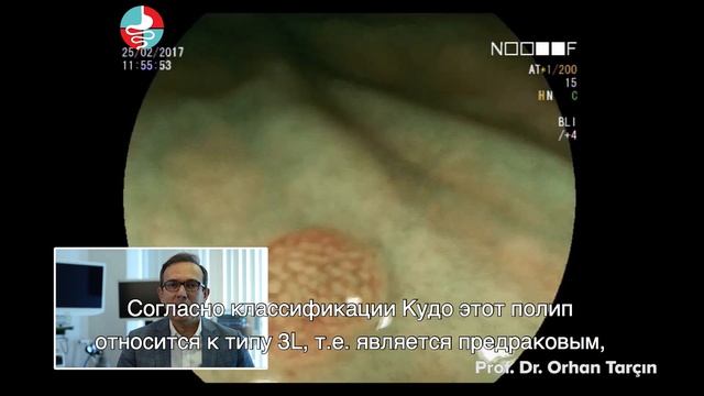 расширенная колоноскопия и полип