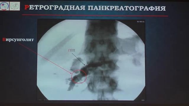 16 Габриэль СА Ретроградная эндоскопическая электрогидравлическая литотрипсия вирсунголита с SpyGla смотреть онлайн