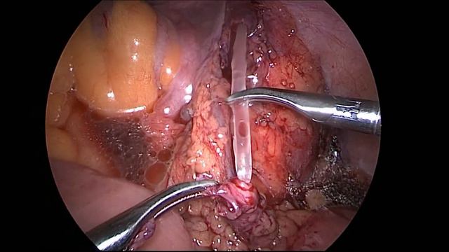 Лапароскопическое замещение стриктуры мочеточника аппендиксом/LAP ureteric replacement by appendix смотреть онлайн