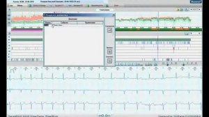 Общие настройки анализа по методике Холтер ЭКГ