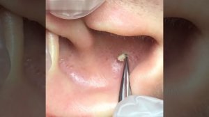 Удаление комедона из ушной раковины | Removing comedones from the auricle