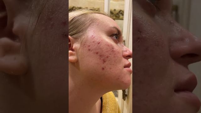что будет с кожей, если не делать чистку лица смотреть онлайн
