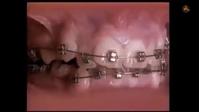 Как брекеты меняют зубы, ускоренное видео. смотреть онлайн