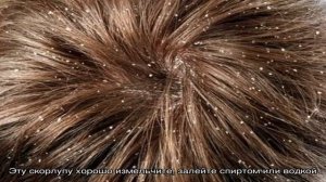 Как лечить себорею головы? Виды себореи. Себорея у взрослых и детей