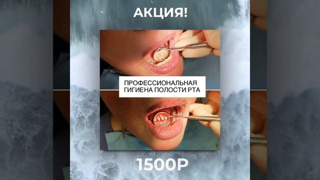 Профессиональная гигиена полости рта всего 1500 т.р смотреть онлайн