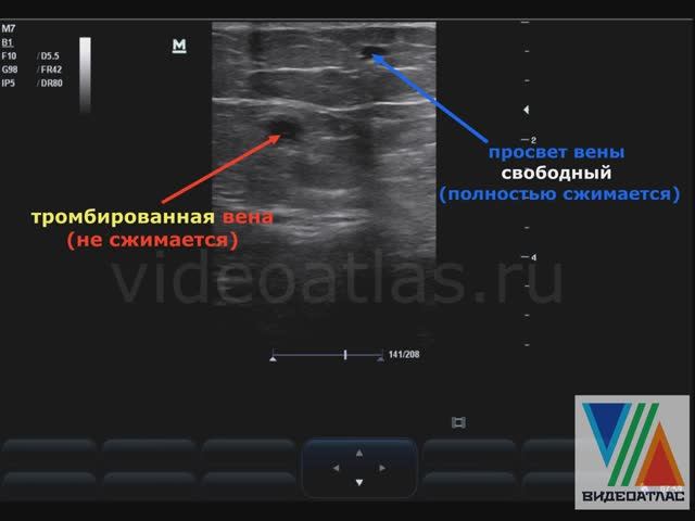 Тромбозы поверхностных вен смотреть онлайн
