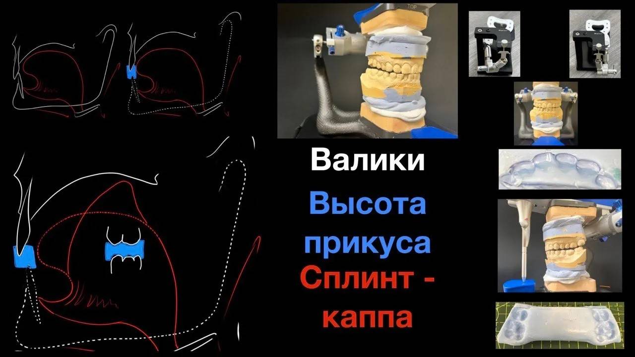 Высота прикуса для каппы МиР - Стоматолог лечит стоматолога #3 - ДВНЧС - ВНЧС - НМР