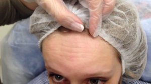 обучение ботокс разметка точек в области лба