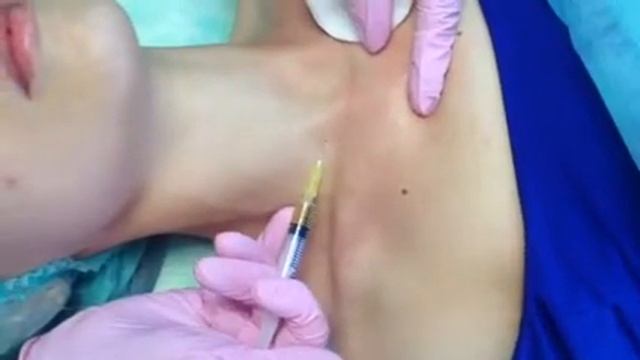 Плазмолифтинг шеи и декольте смотреть онлайн