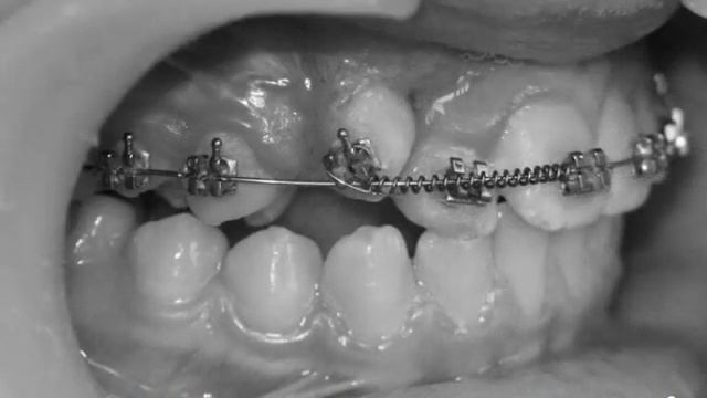 Ретенция клыка, лечение брекетами