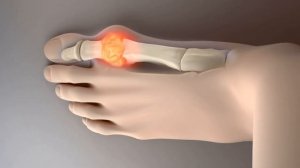 МОЧЕВАЯ КИСЛОТА | Почему уровень мочевой кислоты в крови повышен и что с этим делать