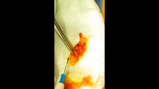 Sentinel Lymph node biopsy in breast cancer by Dual technique смотреть онлайн