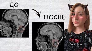 От Страха к Надежде: Мой Опыт Восстановления и Прогресса | Аномалия Арнольда-Киари 1 тип