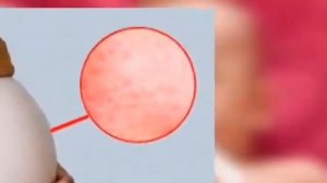 Болезнь «Краснуха»