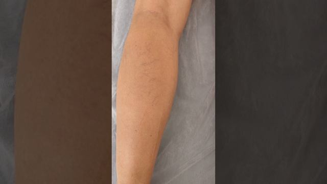 Гормональная сетка. Склеротерапия противопоказана. Флеболог Москва. Флеболог. Сосудистый хирург смотреть онлайн