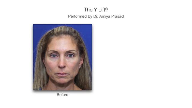 How Skin Damage and Volume Loss from Laser/Thermal Treatments are Avoided and Treated смотреть онлайн