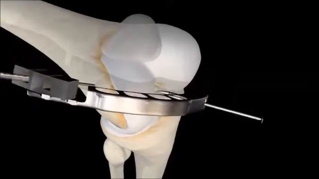 колено связка смотреть онлайн