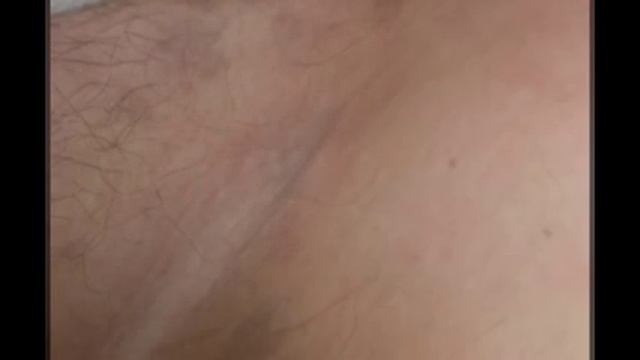 Цветной (отрубевидный) лишай у человека смотреть онлайн