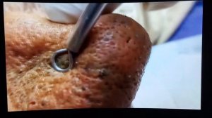 Чёрные угри на носу! Прыщи! Pimples! Acne!