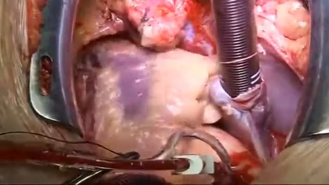 Фибрилляция. Дефибрилляция. смотреть онлайн