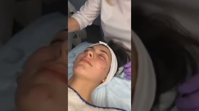 Мезотерапия постакне шрамов