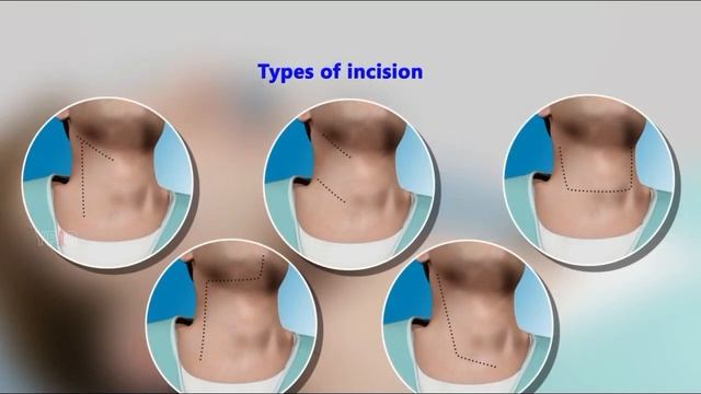 Cervical Lymph Node Dissection: Surgical Procedure, Risks and Complications смотреть онлайн