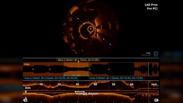 DEFERRED #PCI by #ANATOMICAL #PHYSIOLOGICAL & #IMAGING assessment - #TIPS & #TRICKS by Dr mohan смотреть онлайн