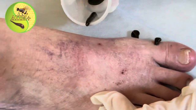Гирудотерапия при Синдром Рейно смотреть онлайн