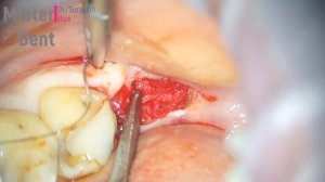 удаление нижнего зуба мудрости , удаление восьмерки , лечение кариеса ,имплантация зуба