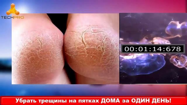 ОТ ТРЕЩИН НА ПЯТКАХ И Следа Не Останется! Рецепт Ванночки… смотреть онлайн