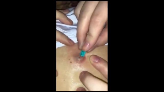 Большой жировик на спине!!!Relax Every Day ?Самое залипательное видео давить прыщи