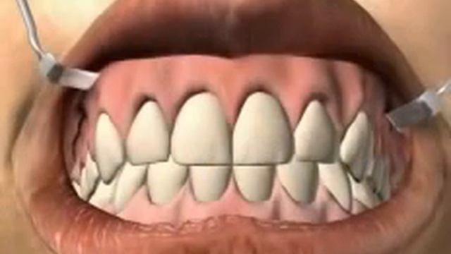 Что такое Свищ Фистула