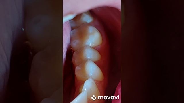 установка пломб в пришеечную область зуба и по жевательной поверхности. диагноз: глубокий кариес смотреть онлайн