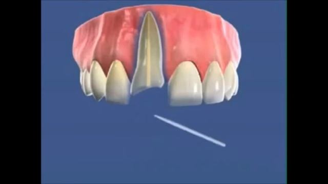 Лечение однокорневого зуба с помощью однокорневого штифта. Стоматология. Эндодонтия.