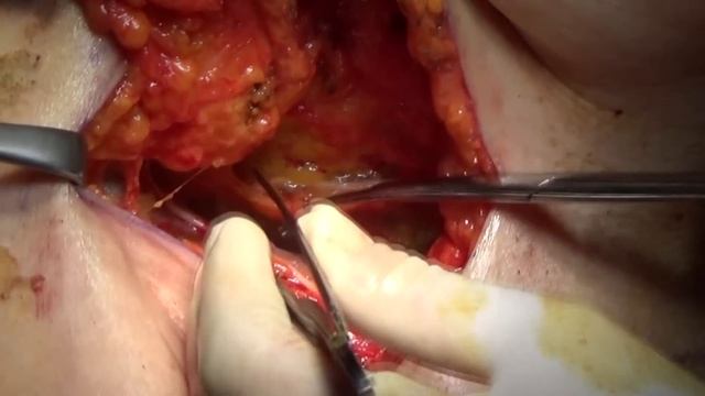Axillary lymph node dissection смотреть онлайн