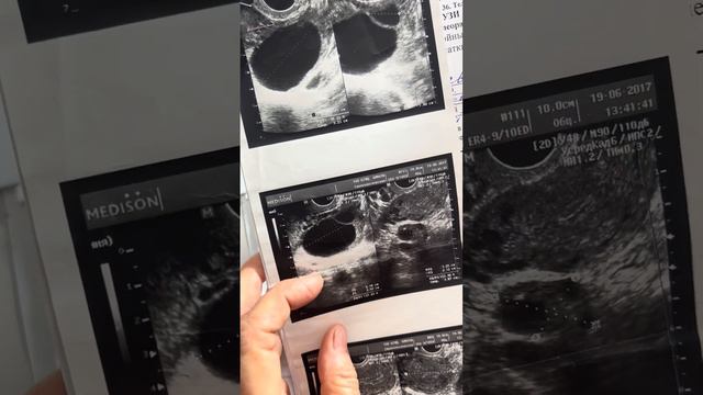 Расскажу о рассасывании кист яичников.   гормональные кисты ,эндометриоидные и  муцинозные.