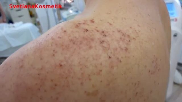 IPL - SHR Super permanent Hair Removal Technologie dauerhafte Haarentfernung Лазернаая эпиляция смотреть онлайн