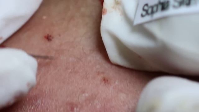 Daily Video Relaxing With Sophia Skin Care, Acne, Whiteheads & Blackheads #037